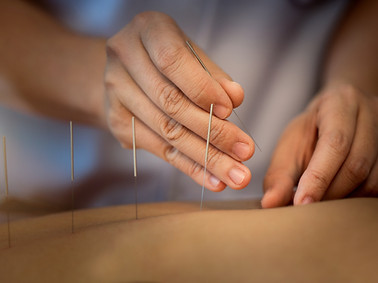 Acupuncture treatment close up